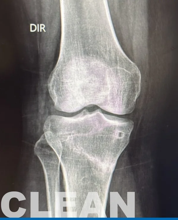 Radiografia do joelho do site original UniPlasty