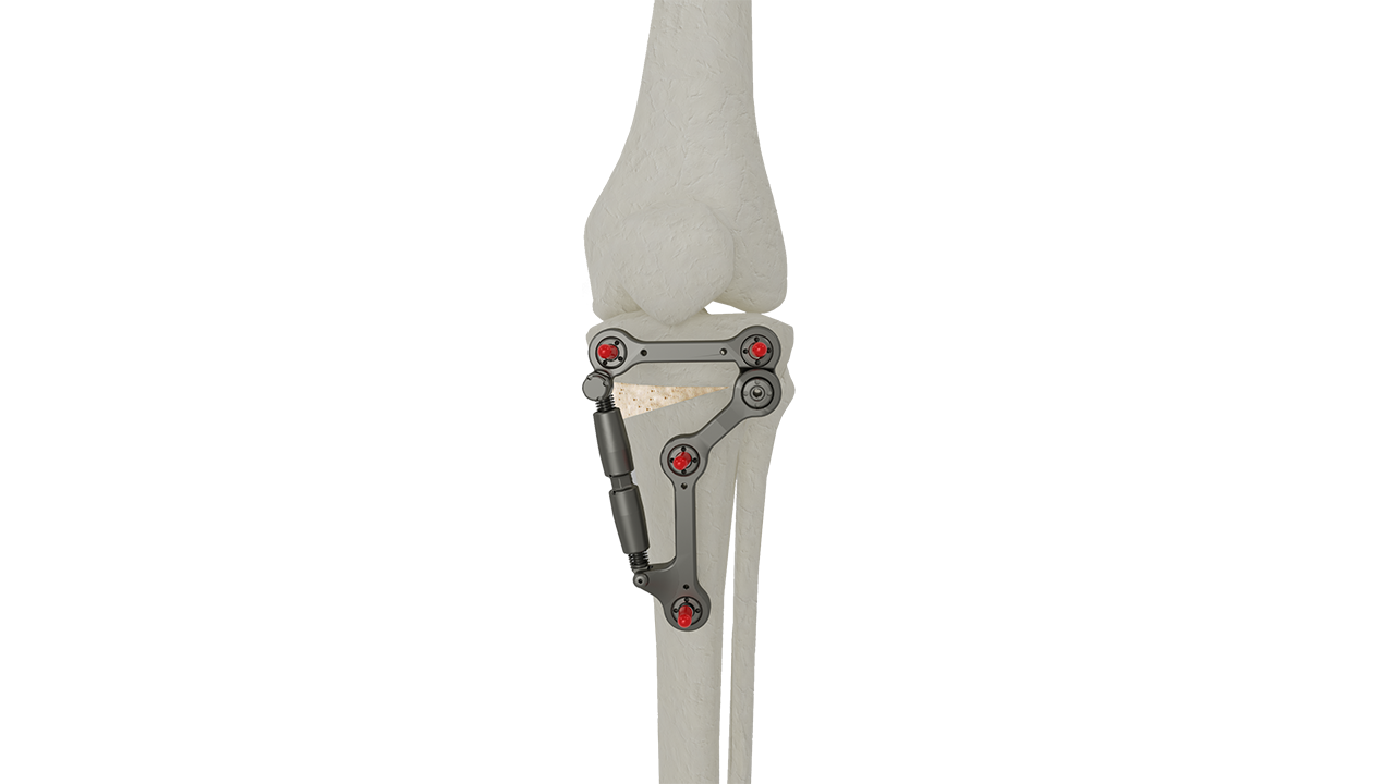 Sistema UniPlasty num modelo ósseo
